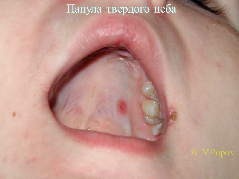 Папула твердого неба